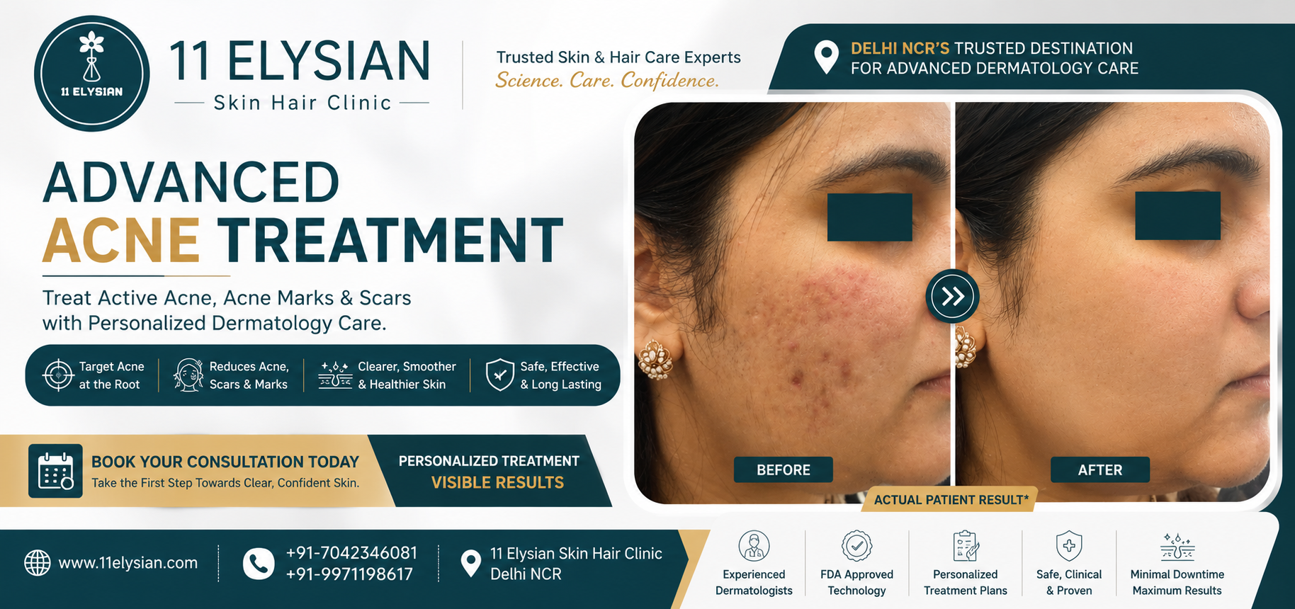 Acne Treatment Near Gaur City 1, Greater Noida West